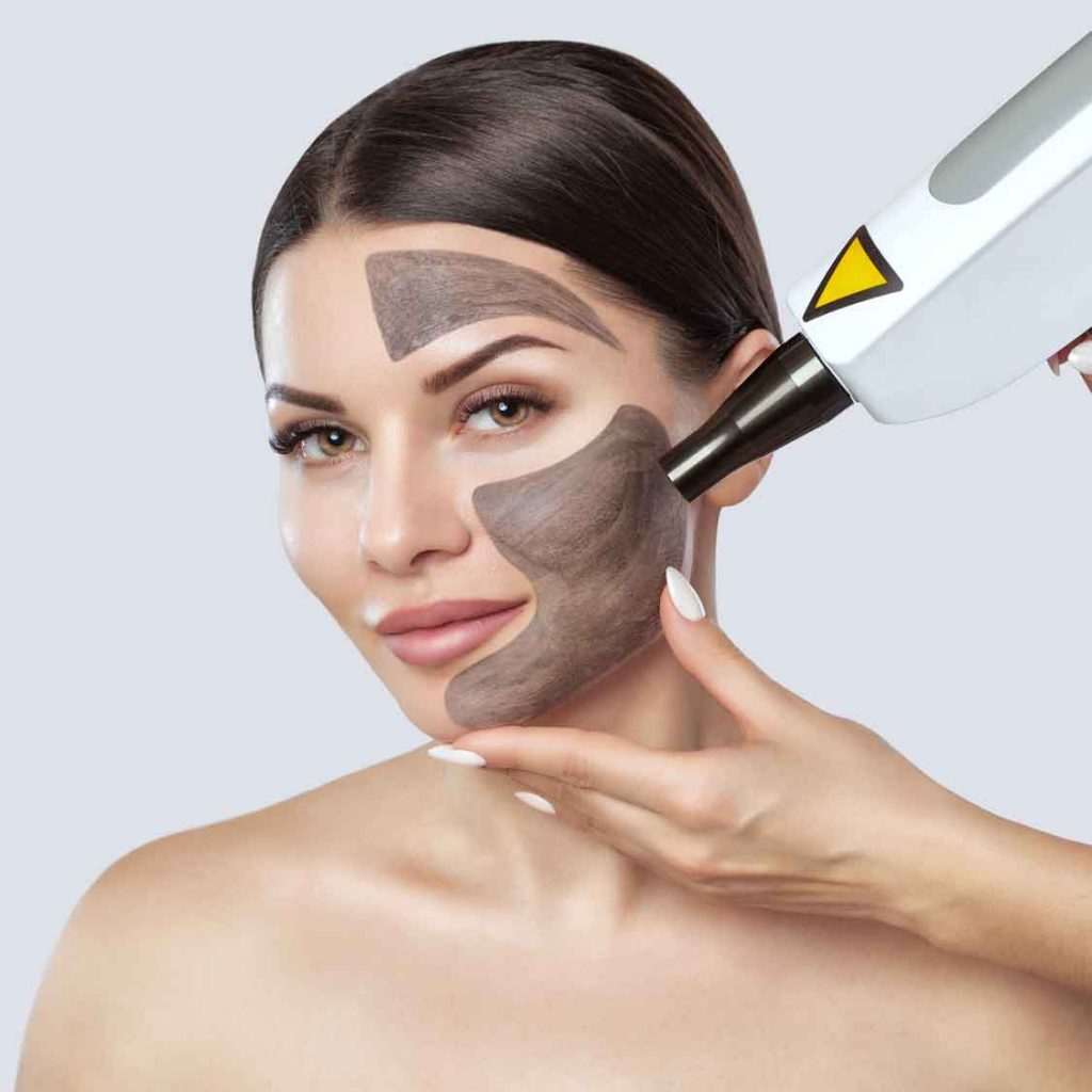 Advantages of Carbon Peeling of the Skin in the Salon1